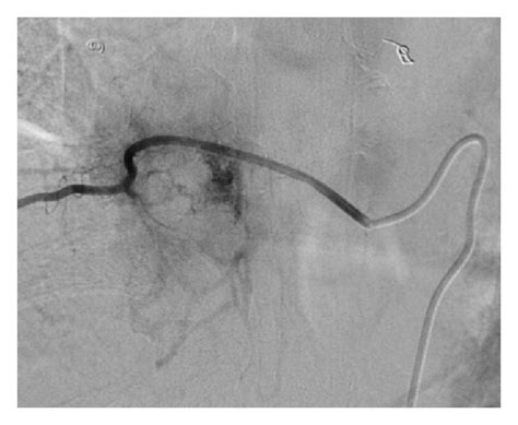 Preoperative Spinal Angiogram Showing A Tumor Blush T Intercostal