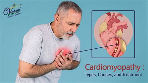 Vedobi - Cardiomyopathy : Types, Causes, and Treatment