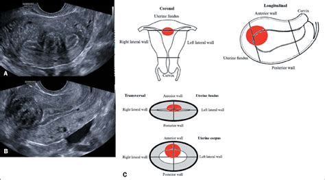 Uterine Fibroids Ultrasound