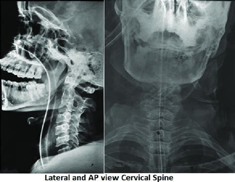 X-ray cervical spine with AP and lateral radiographs showing fusion of... | Download Scientific ...