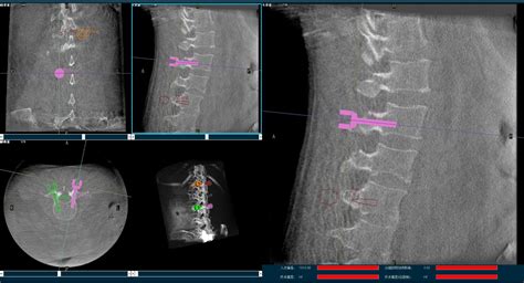 Percutaneous Pedicle Screw Fixation Assisted With Perlove Medicals