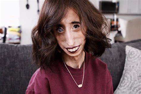 Lizzie Velasquez Before And After