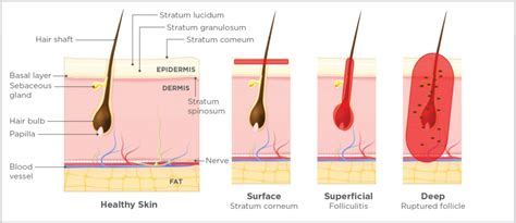 Pyoderma in the Dog | Today's Veterinary Nurse