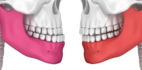 Overjet Vs Overbite