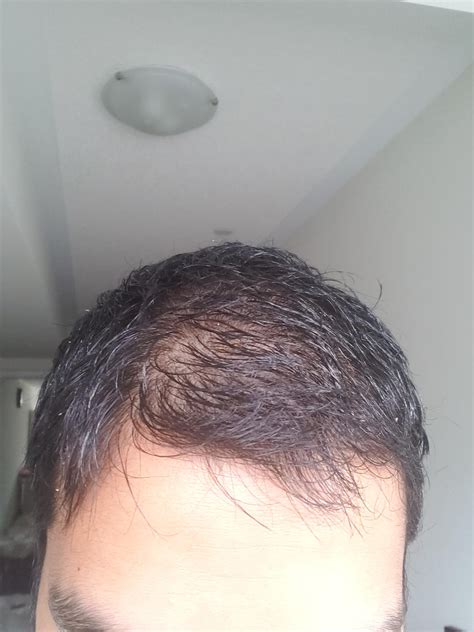 Itchy Scalp + Hair Loss : r/HaircareScience