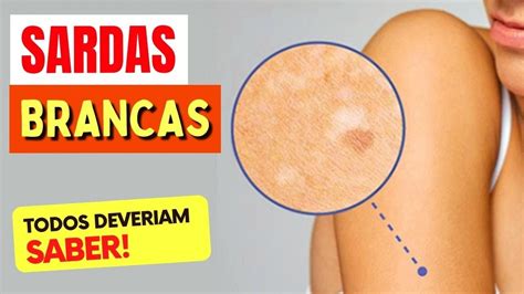 SARDAS BRANCAS Coisas Que TODO MUNDO DEVERIA SABER