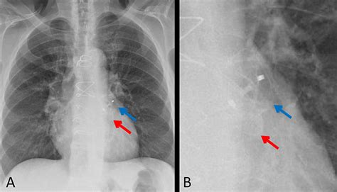 Amulet Left Atrial Appendage Closure Device