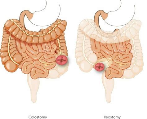 Ileostomy Diagram