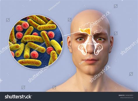 Sinusitis Inflammation Paranasal Cavities 3d Illustration Stock