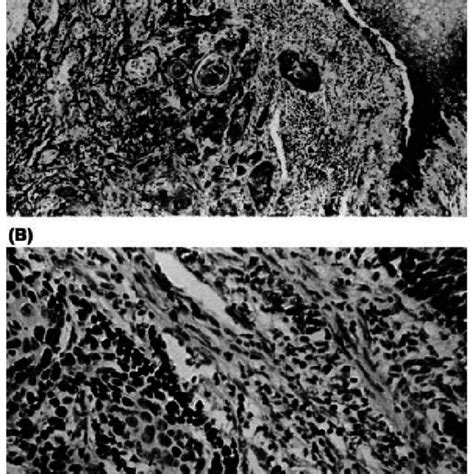 A Squamous Cell Carcinoma Stained With Hematoxylin And Eosin ´100 Download Scientific