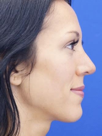 Prominent Nose Closed Rhinoplasty