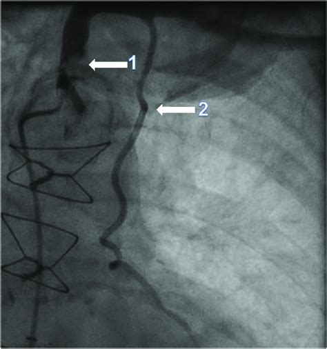 Cardiac Catheterization With An Anteroposterior View Demonstrating