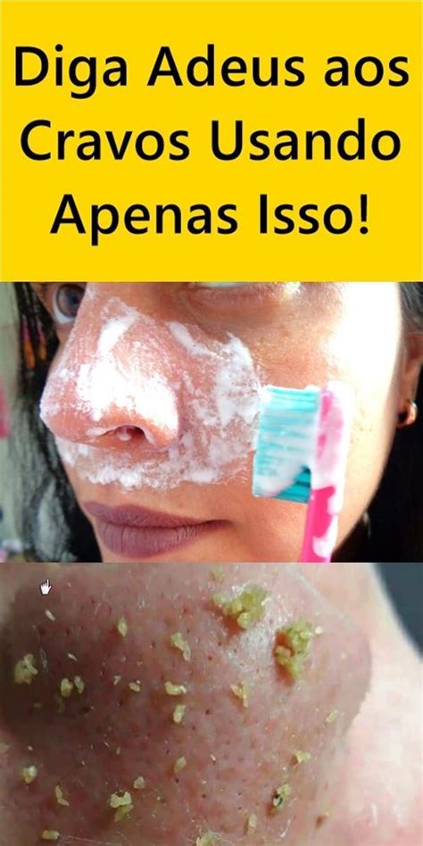 Diga Adeus Aos Cravos Usando Apenas Isso Cravos E Espinhas Remover