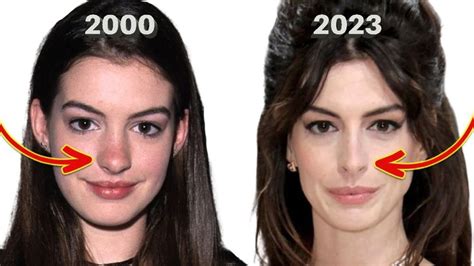 Anne Hathaways Before And After Denies Nose Job Lorry Hill Nose