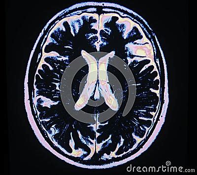 Mri Brain Stroke Royalty-Free Stock Image | CartoonDealer.com #52527988