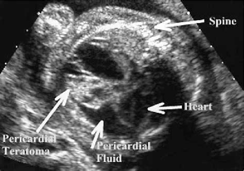 Fetal Pericardial Effusion Ultrasound