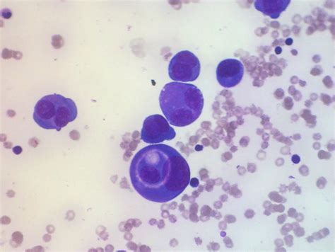 The Cell Hunter Society: Case No. NGC2097-11 Pleural Fluid