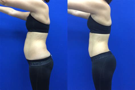 I Tried Laser Liposuction — Before And After Laser Liposuction Photos