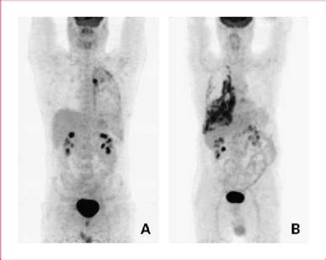 Squamous Cell Carcinoma Of The Lip Pictures