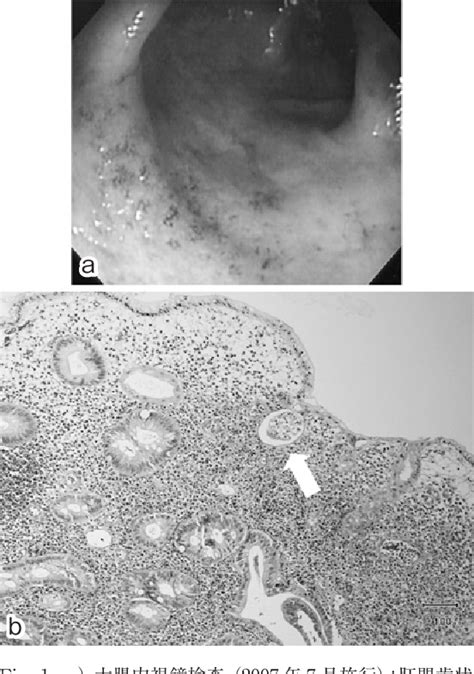 Figure 2 from A Case of Fulminant Amoebic Colitis Complicated with ...