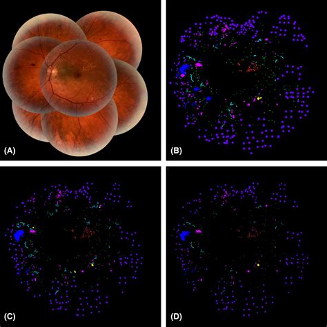 Agreement Between Experts In The Detection Of Diabetic Retinopathy