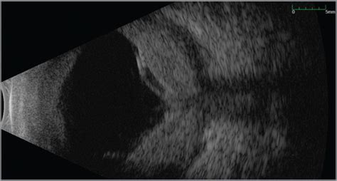 Posterior Scleritis Ophthalmic Surgery Lasers And Imaging Retina