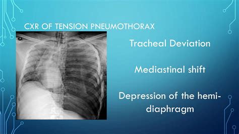 Tension Pneumothorax Ppt Download