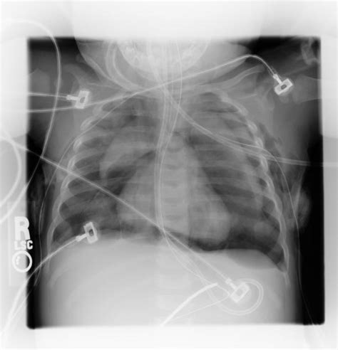 Pneumomediastinum - wikidoc