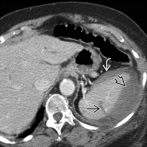 Figure 1 Ct Scan Image Depicting Grade 3 Splenic Laceration Is Shown