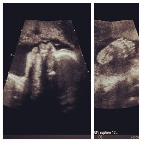 Third Trimester Ultrasound — The Bump