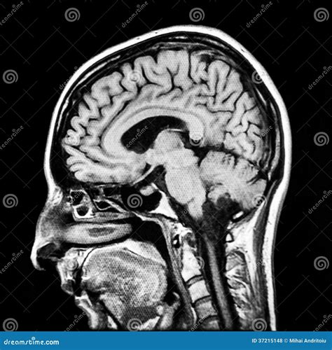 Human Brain Mri Scan Royalty Free Stock Photos Image