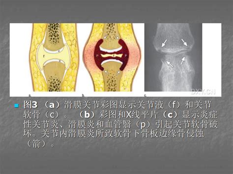 关节炎的x线评价，太全面了！ 好医术早读文章 好医术 赋能医生守护生命