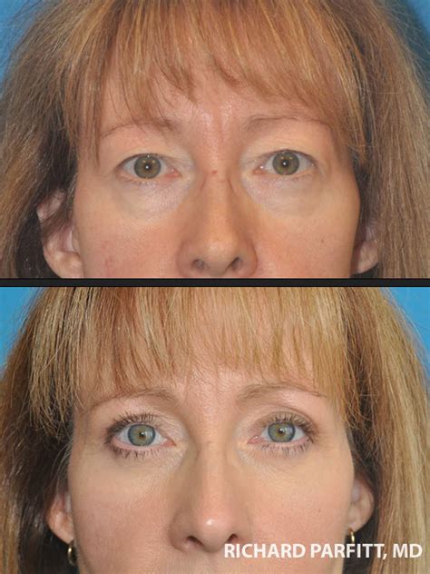 Eyelid Surgery Before And After Photos