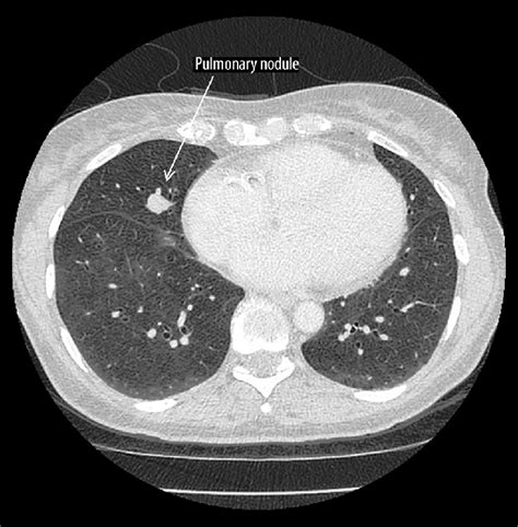 High Resolution Computed Tomography Hrct Of The Lung A 13 Mm Nodule