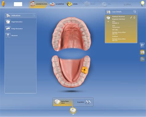 Fabricating An Implant Restoration In A Single Visit With Vita Enamic Is