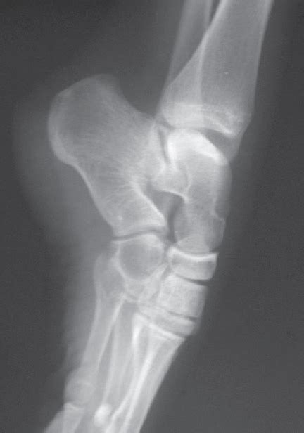 Figure 1 From Management Of Posterior Ankle Impingement As A Result Of