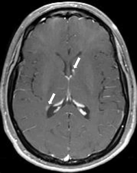 Tuberous Sclerosis Complex Tsc Renal And Extrarenal Imaging Academic Radiology