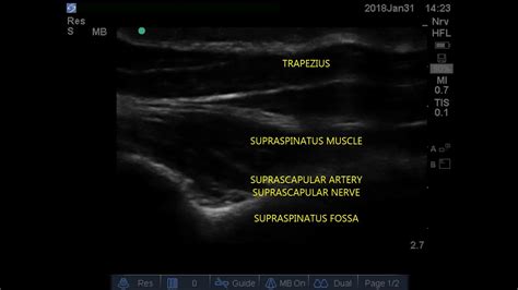 Usg Guided Screening For Suprascapular Nerve Block Youtube