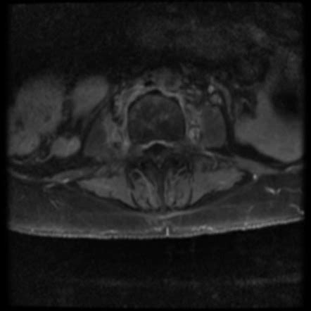 Spinal Discitis Osteomyelitis Image Radiopaedia Org