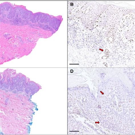 Representative Examples Of Secondary Extramammary Paget Disease Empd