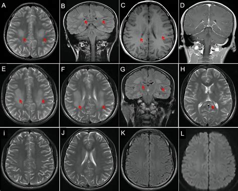 Frontiers Case Report Early Onset Charcot Marie Tooth 2N With