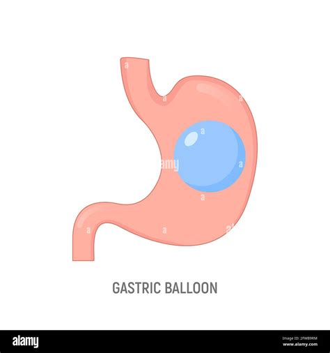 Gastric Balloon Weight Loss Intragastric Surgery Stomach Gastric