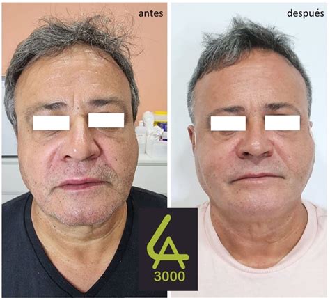 Antiaging Rellenos Faciales