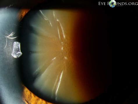 Brunescent cataract: The University of Iowa, Ophthalmology