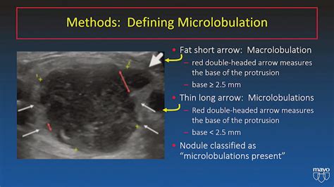 Ti Rads Ultrasound