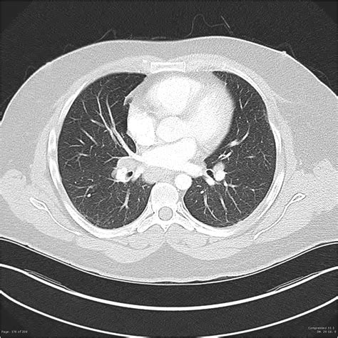 Neurosarcoidosis Image Radiopaedia Org