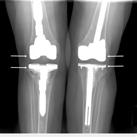 Preoperative X Ray Showing Hardware Prior To Bilateral Revision Total Download Scientific