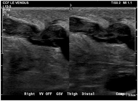 Thrombophlebitis Ultrasound