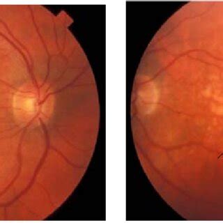 Examples of retina images obtained by fundus photography. | Download Scientific Diagram