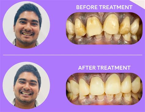 Overbite Before and After Braces: Transformative Results! - Dezy